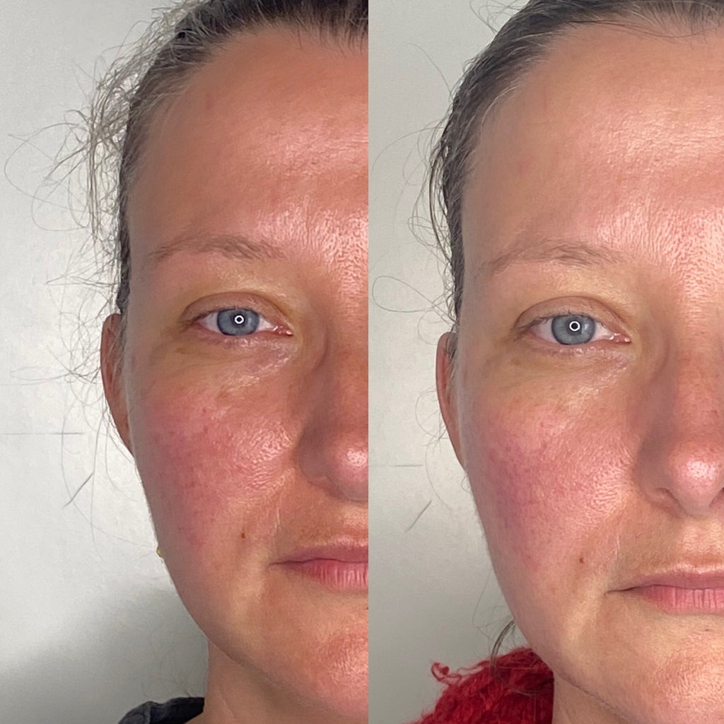 Kosmetisk akupunktur 60 min.